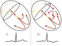 Accessory Pathway Conduction Compared to Normal Conduction Accessory Pathway Illustration, WPW Illustration, Wolff-Parkinson-White