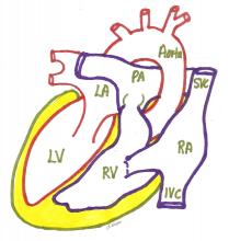 Dextrocardia Situs Inversus Dextrocardia situs inversus