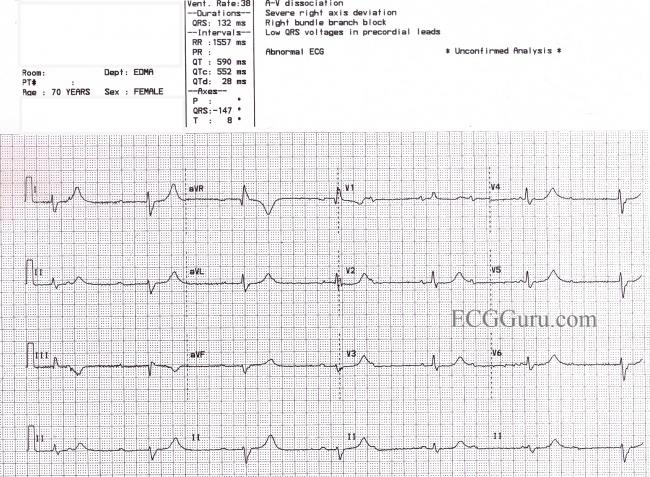 Long QT Syndrome ECG Guru Instructor Resources