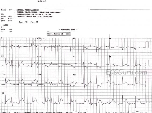 septal-infarct-age-undetermined