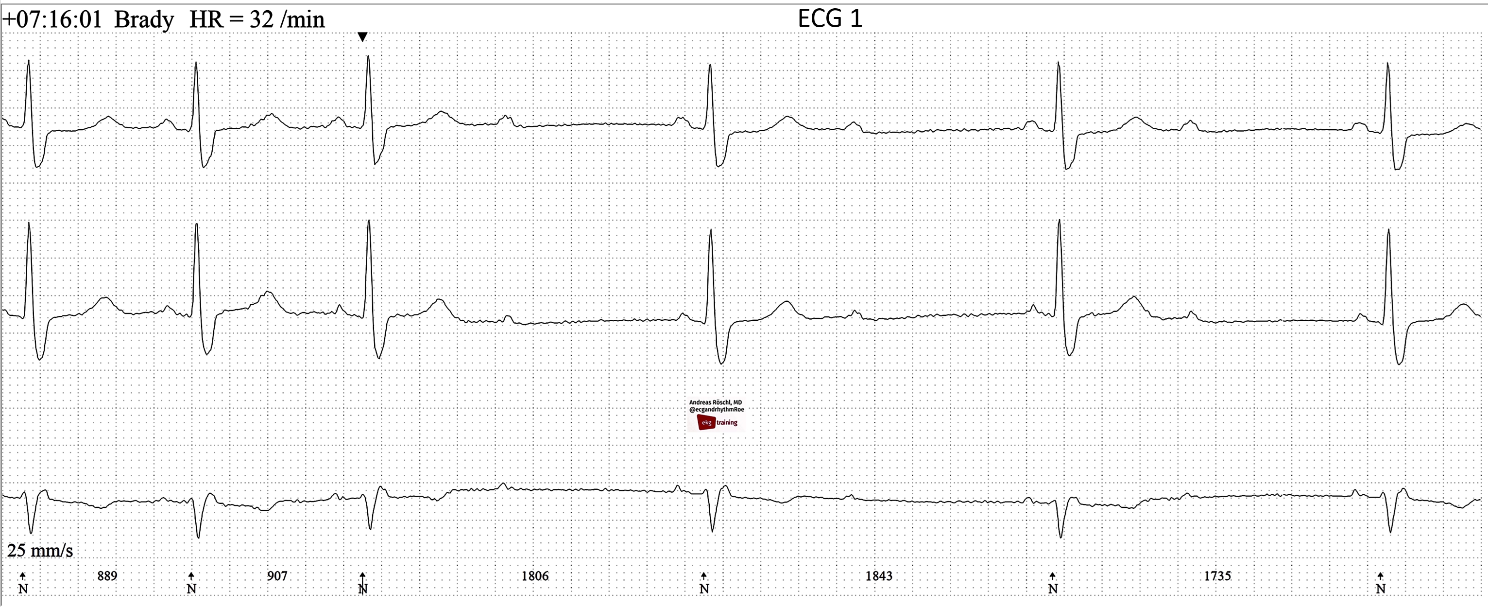 Second degree AV Block With 2 1 Conduction ECG Guru Instructor 