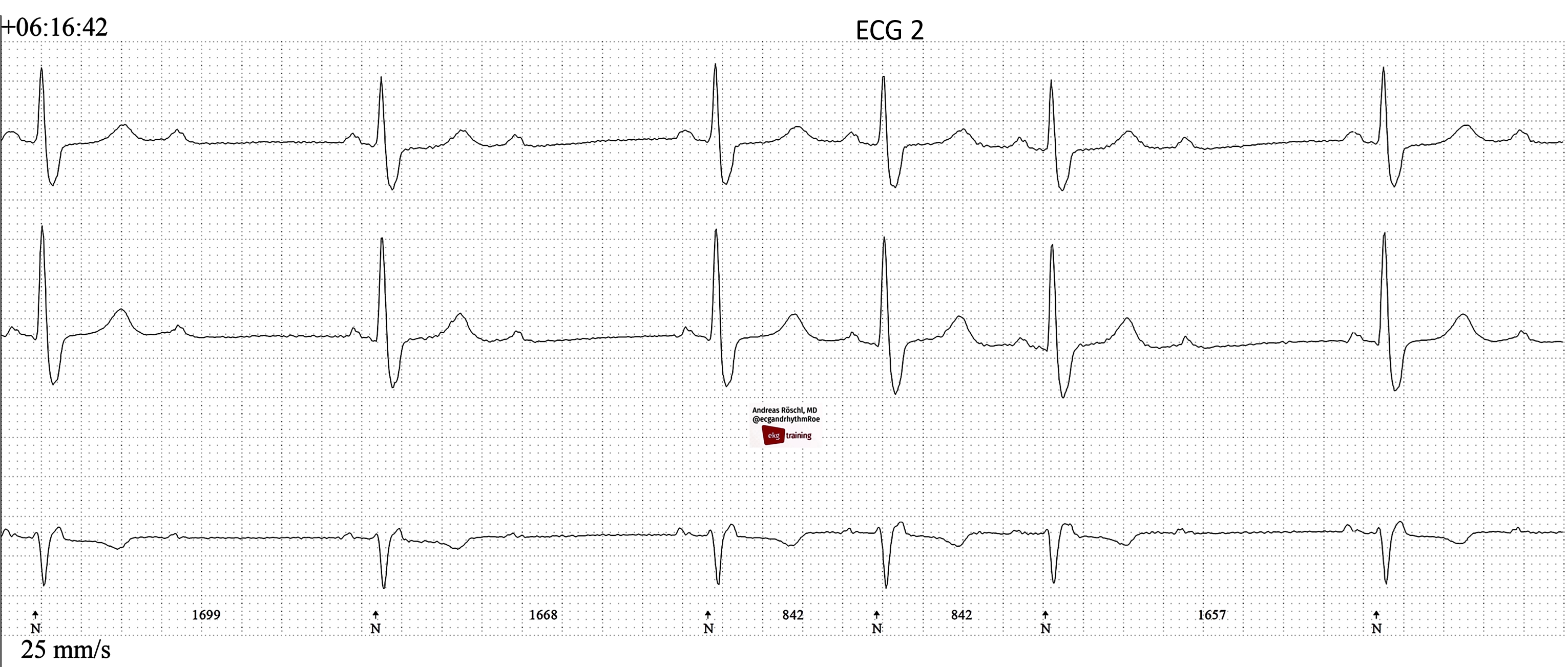 Nonspecific intraventricular conduction delay (defect) – ECG & ECHO