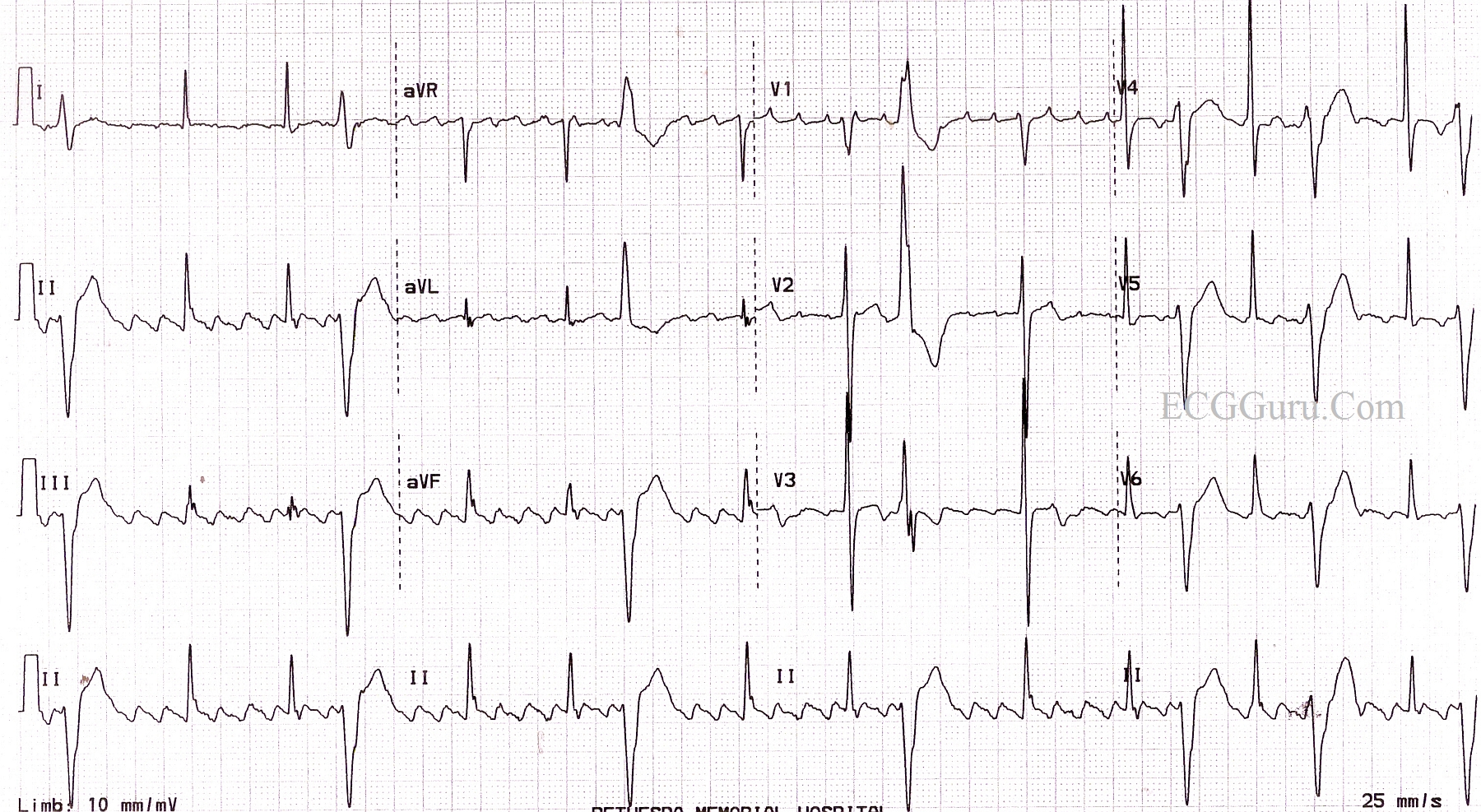 Ecg Showing Typical Atrial Flutter With Ventricular R