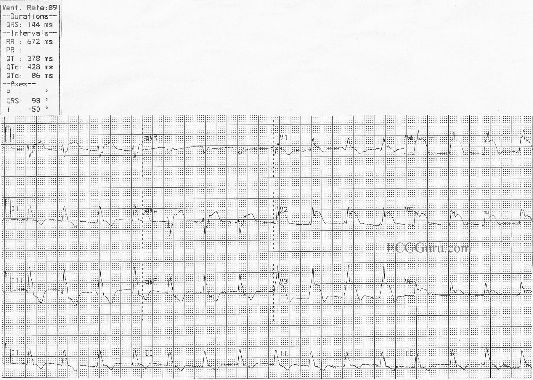 Acute Anterior-lateral M.I. With Right Bundle Branch Block and Left ...