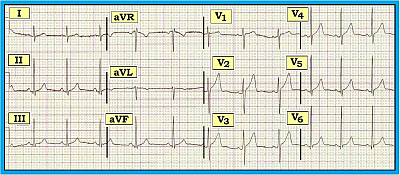 Early Repolarization | ECG Guru - Instructor Resources