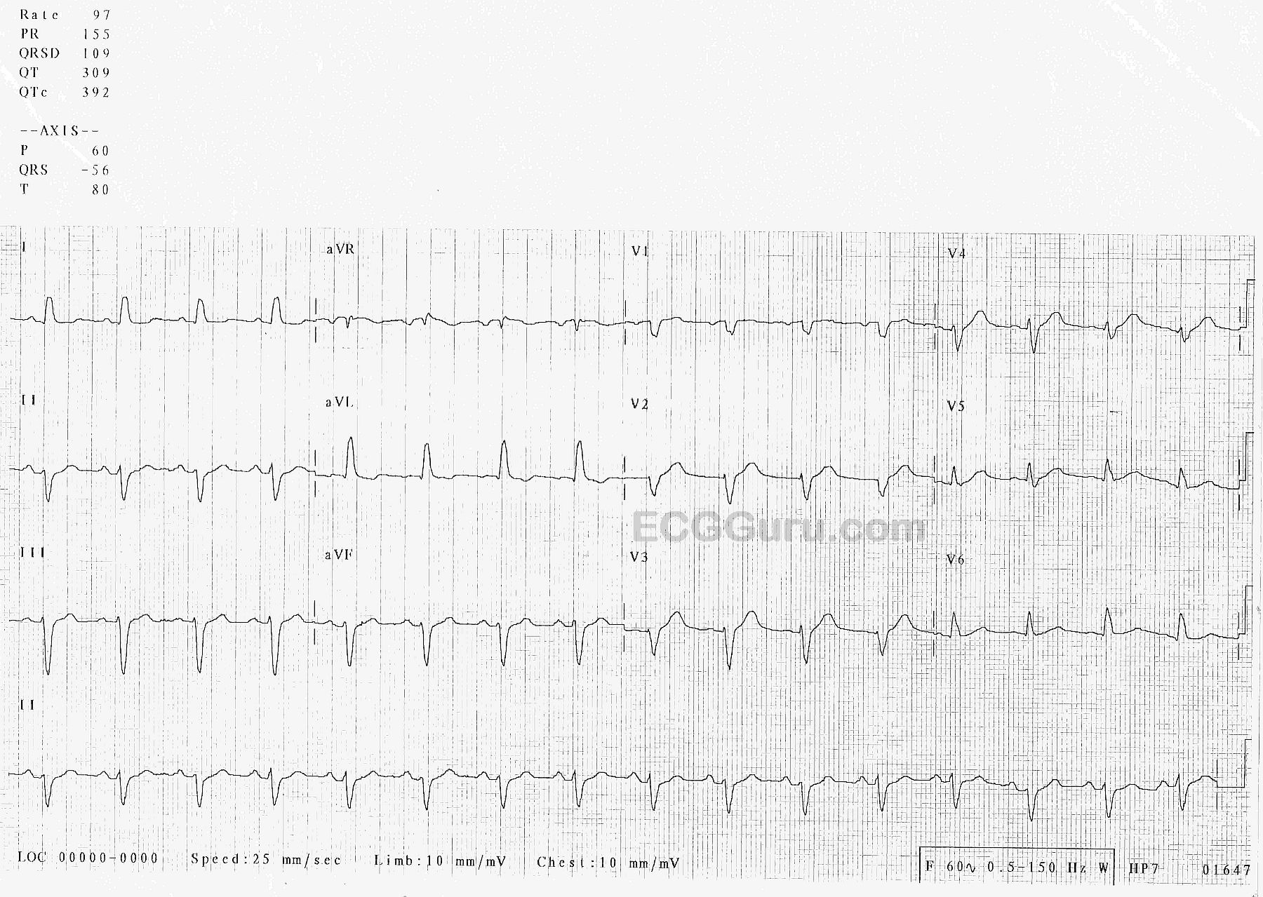 Nonspecific intraventricular conduction delay (defect) – ECG & ECHO