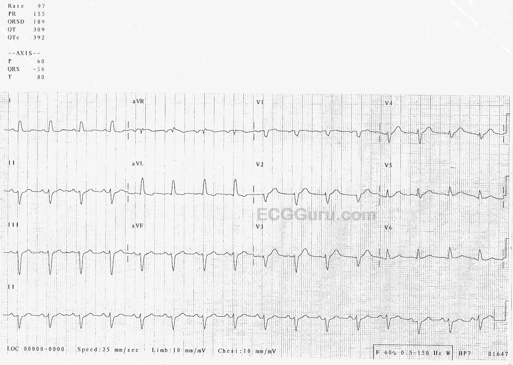 Instructors Collection ECG Non specific IVCD With Peaked T Waves 