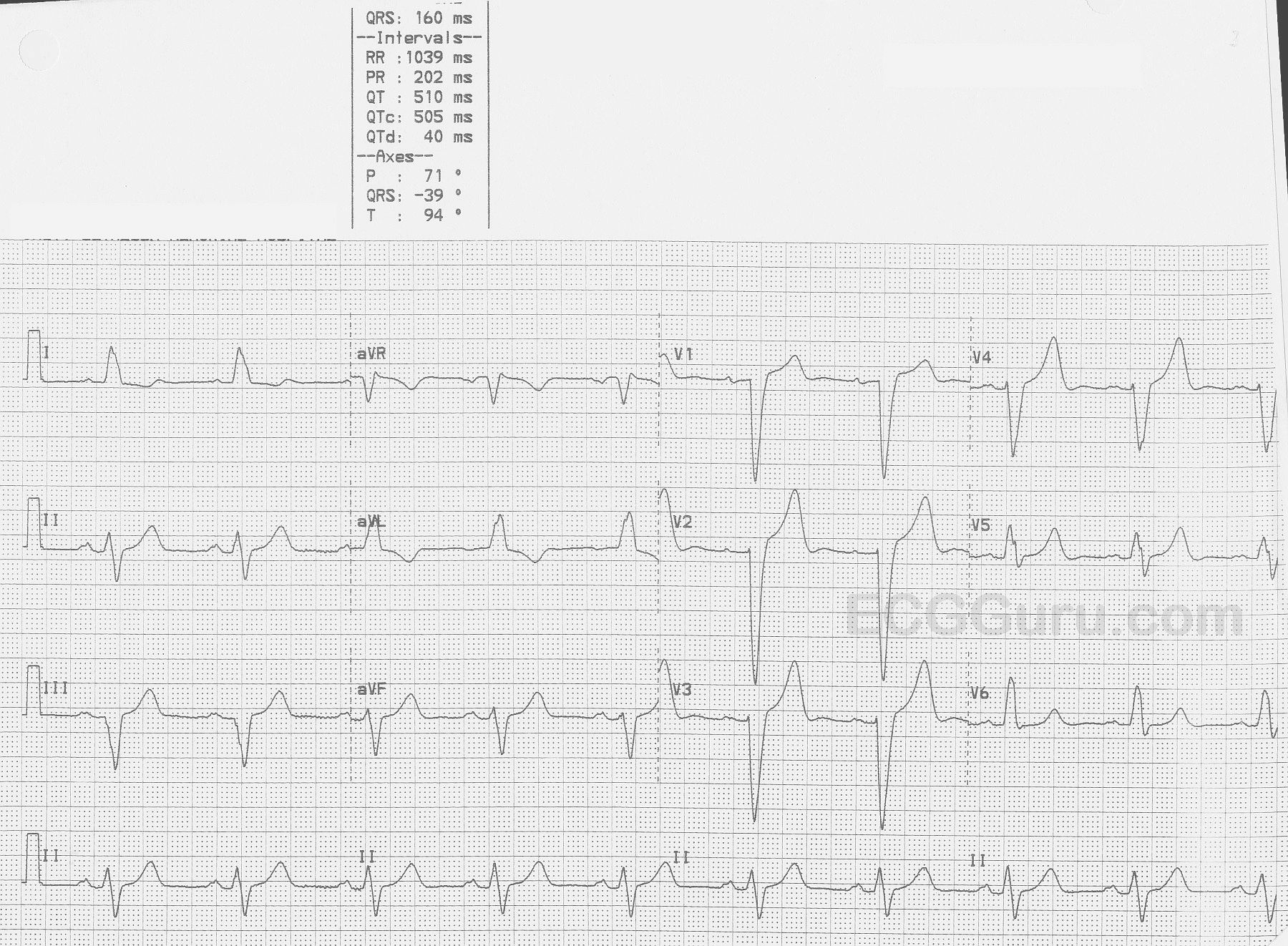 Left Bundle Branch Block ECG Guru Instructor Resources