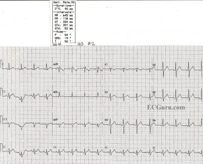 NSR after conversion from atrial flutter with 1:1 conduction