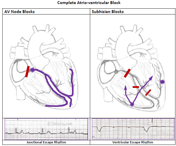 Atrioventricular Block, Heart Block