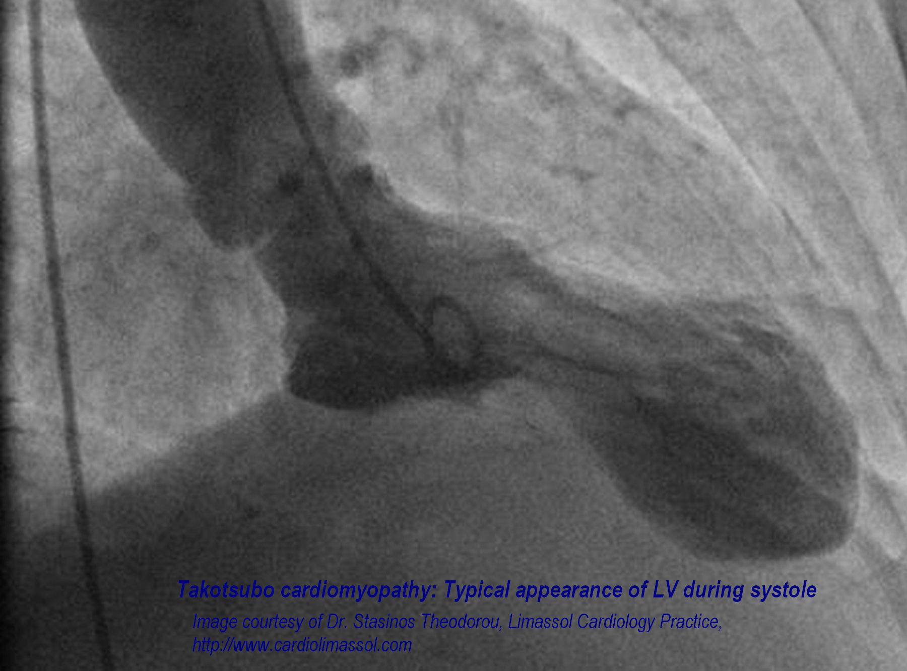 Familial apical dilated cardiomyopathy in a young man: a novel phenotype of  Takatsubo syndrome or a new entity altogether?