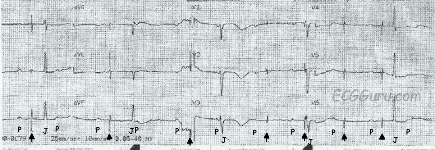 ECG Basics: Pacemaker Failure to Capture | ECG Guru - Instructor Resources