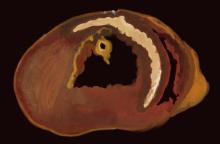 Anterior-septal M.I. cross-section illustration