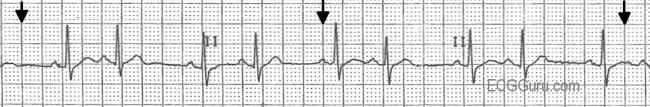 ECG Basics: Sinus Rhythm With Atrial Bigeminy | ECG Guru - Instructor ...