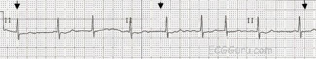 ECG Basics: Atrial Fibrillation With A Controlled Ventricular Response ...