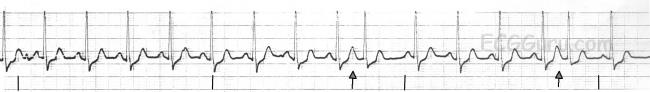 V Tach | ECG Guru - Instructor Resources