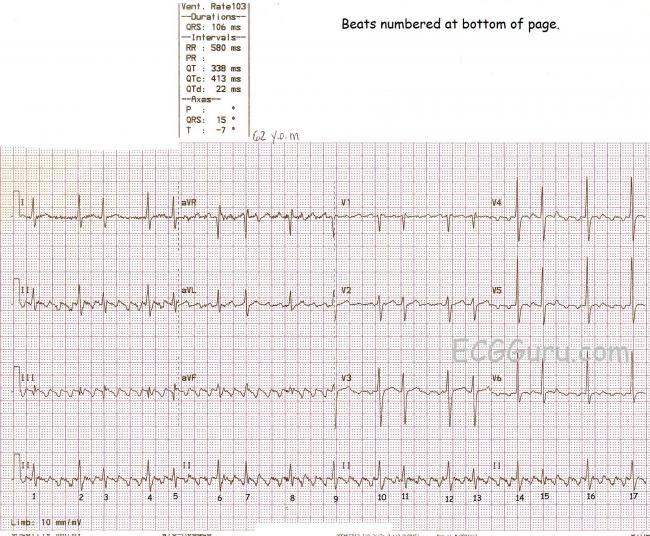 typical atrial flutter and ecg