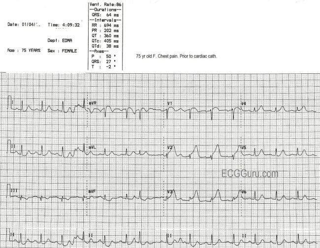 Coronary artery disease | ECG Guru - Instructor Resources