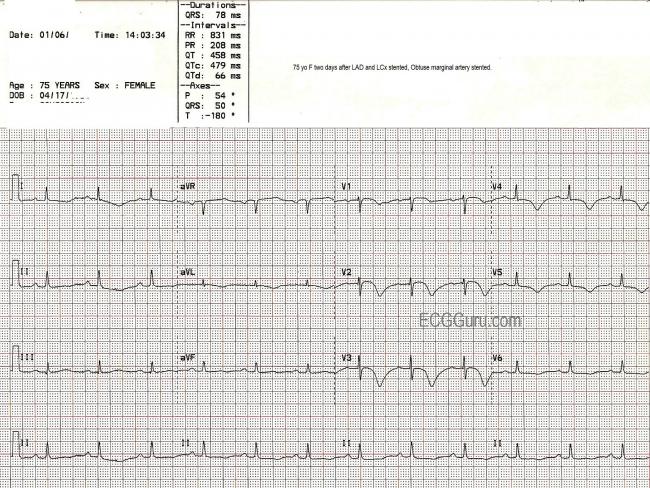 CAD | ECG Guru - Instructor Resources