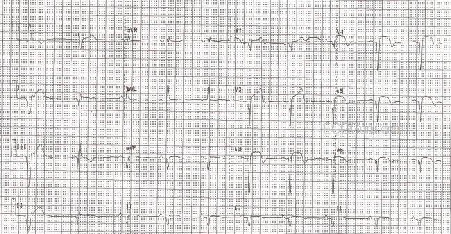 Anterior Wall M.I. With Previous Inferior Wall M.I. | ECG Guru ...