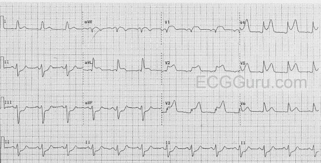 ivcd with st elevation