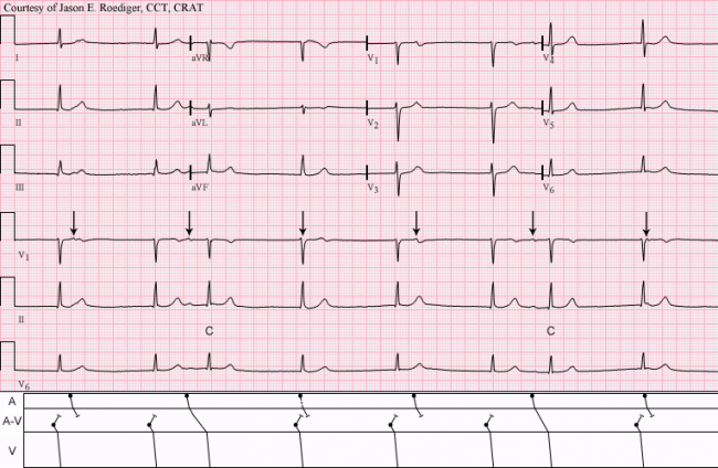 Complete Av Block With Junctional Escape Rhythm Ecg G - vrogue.co