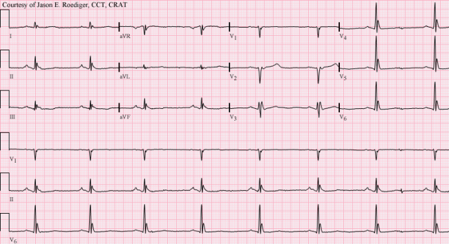 ecg 23