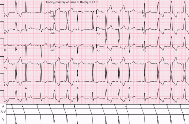 hx of atrial flutter icd 10
