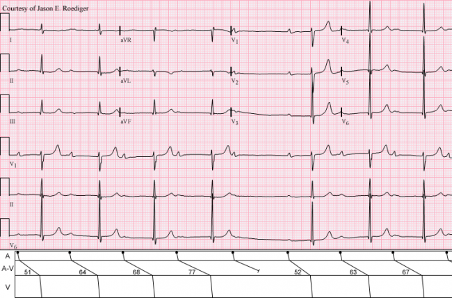 2:1 AV block  ECG Guru - Instructor Resources