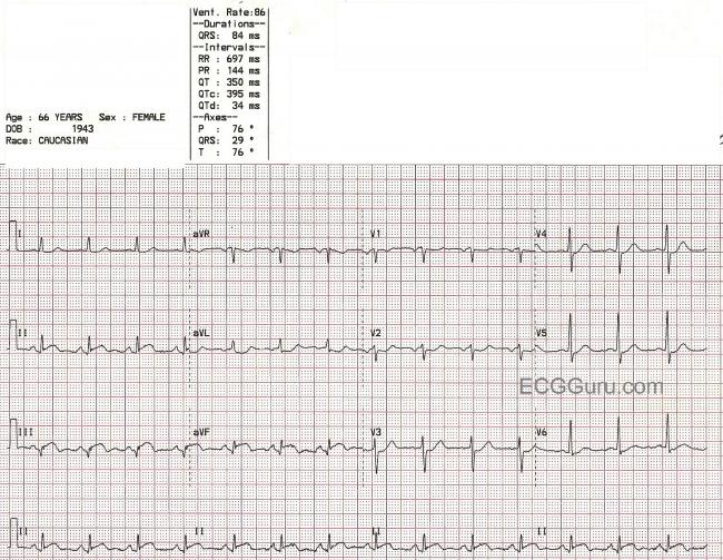 Ventriculogram | ECG Guru - Instructor Resources