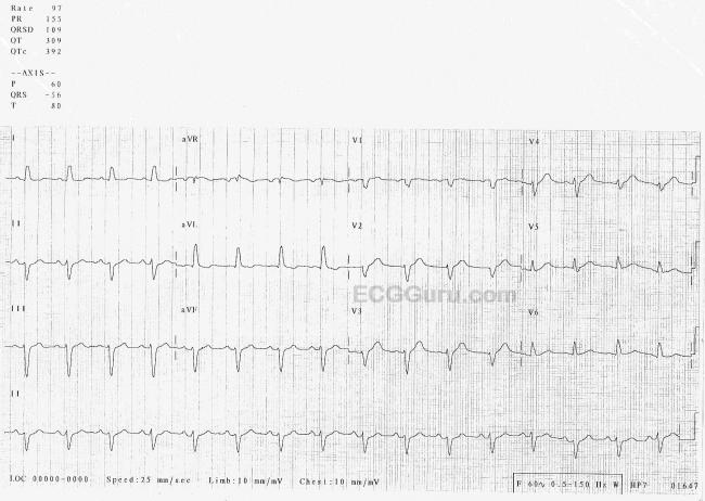 sinus rhythm with ivcd meaning