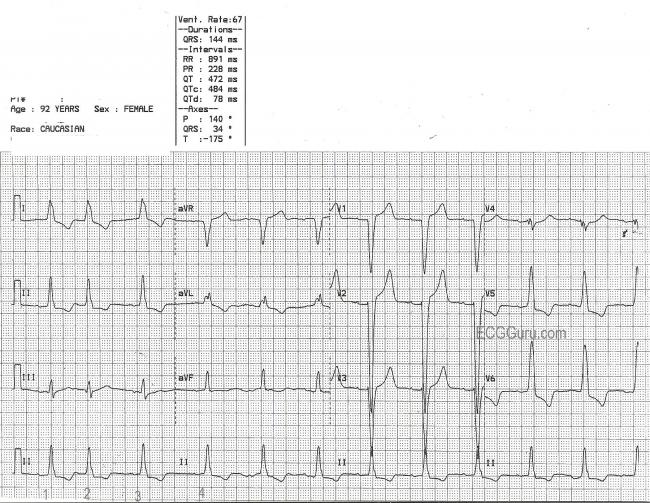 Left Bundle Branch Block | ECG Guru - Instructor Resources