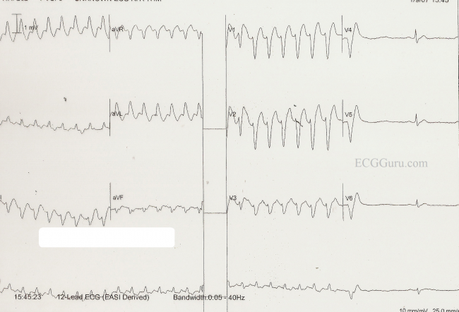 Tachycardia Converted by Adenosine ECG Guru