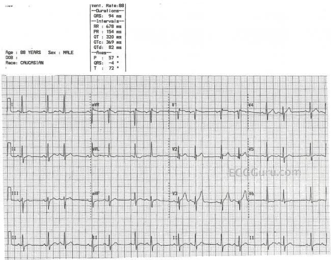 Bigeminal Rhythm | ECG Guru - Instructor Resources