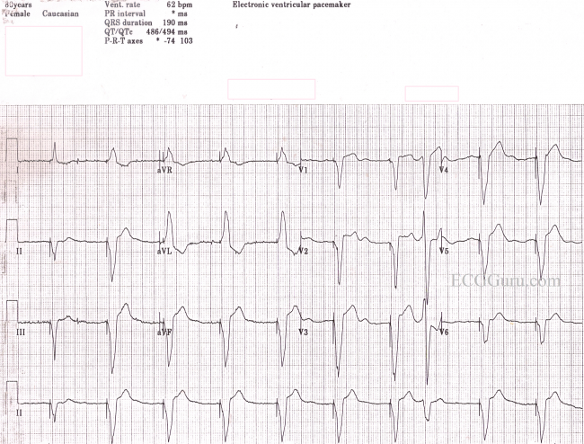 pacemaker av sequential ekg