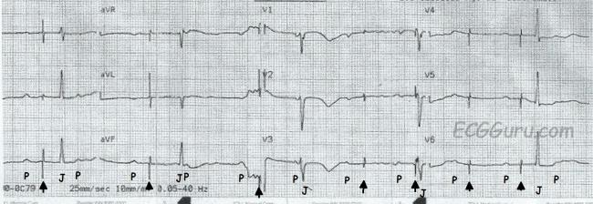 failure to capture pacemaker