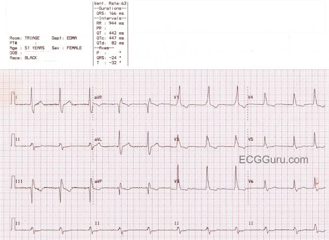 Right Bundle Branch Block With Atypical QRS In V1 And LAFB Or ...