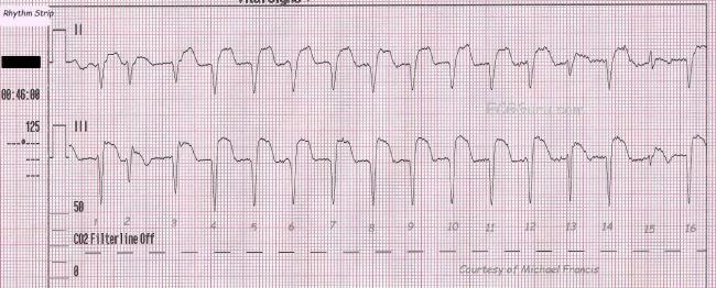 Accelerated idioventricular rhythm | ECG Guru - Instructor Resources