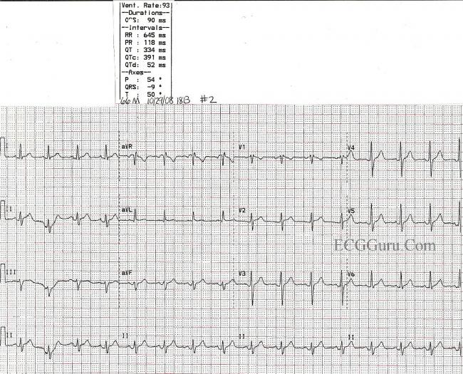 Atrial Flutter With 1:1 Conduction and Rate-dependent Right Bundle ...