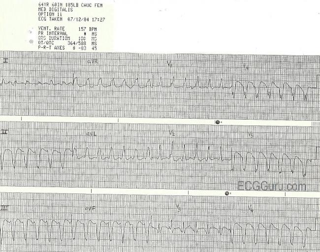 V Tach | ECG Guru - Instructor Resources